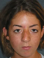Before Cheek Implants, Rhinoplasty, Mandibular Advancement, Genioplasty