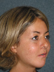 After Cheek Implants, Rhinoplasty, Mandibular Advancement, Genioplasty