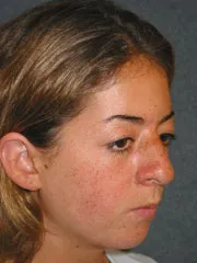 Before Cheek Implants, Rhinoplasty, Mandibular Advancement, Genioplasty