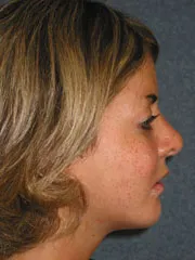 After Cheek Implants, Rhinoplasty, Mandibular Advancement, Genioplasty