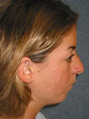 Before Cheek Implants, Rhinoplasty, Mandibular Advancement, Genioplasty
