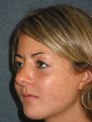 After Cheek Implants, Rhinoplasty, Mandibular Advancement, Genioplasty