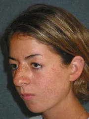 Before Cheek Implants, Rhinoplasty, Mandibular Advancement, Genioplasty