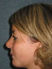 After Cheek Implants, Rhinoplasty, Mandibular Advancement, Genioplasty