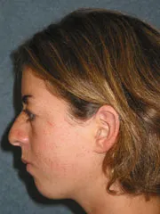 Before Cheek Implants, Rhinoplasty, Mandibular Advancement, Genioplasty
