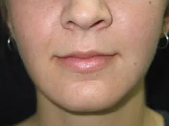 after Chin Implant