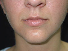 before Chin Implant