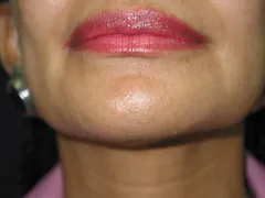 after Chin Liposuction