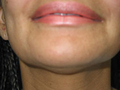 before Chin Liposuction