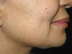 before Chin Liposuction
