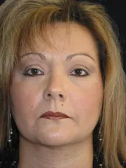 after Chin Liposuction