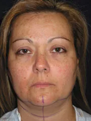 before Chin Liposuction