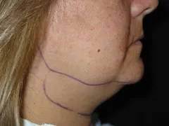 before Chin Liposuction