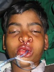 After Cleft Lip and Palate