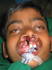 Before Cleft Lip and Palate