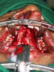 After Cleft Lip and Palate