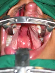 Before Cleft Lip and Palate