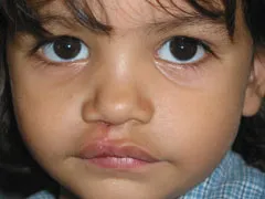 After Cleft Lip and Palate