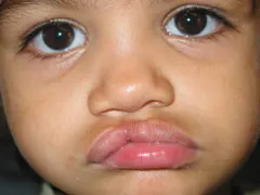 Before Cleft Lip and Palate