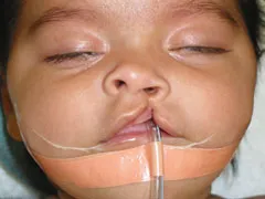 Before Cleft Lip and Palate