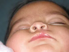 After Cleft Lip and Palate
