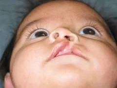 Before Cleft Lip and Palate