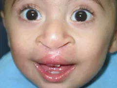 After Cleft Lip and Palate