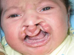Before Cleft Lip and Palate