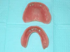 After Dental Implants
