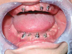 Before Dental Implants