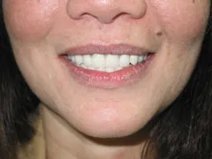 Before Dental Implants
