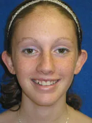 before Ear Surgery