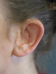 after Ear Surgery