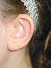 before Ear Surgery