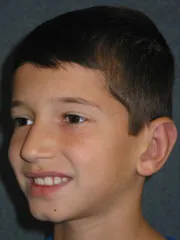 after Ear Surgery
