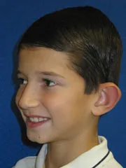 before Ear Surgery