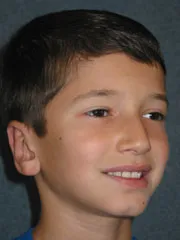 after Ear Surgery