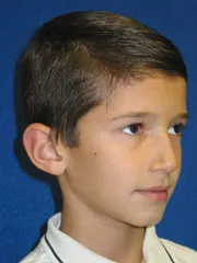 before Ear Surgery