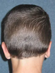 after Ear Surgery