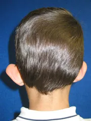 before Ear Surgery