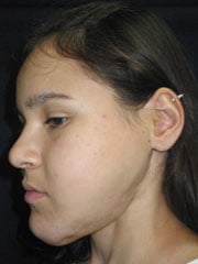 After Facial Reconstruction