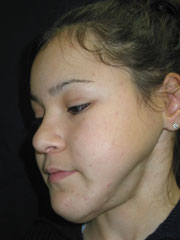 Before Facial Reconstruction