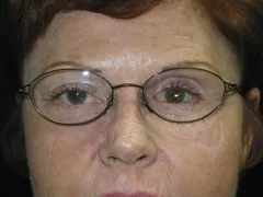 After Facial Reconstruction