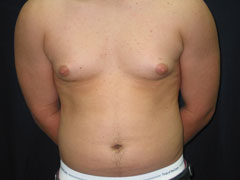 Before Gynecomastia Correction