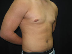 After Gynecomastia Correction
