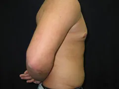 After Gynecomastia Correction