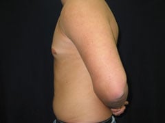 After Gynecomastia Correction