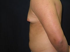 Before Gynecomastia Correction