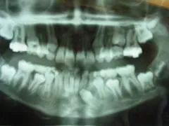 After Surgical Exposure of Impacted Canine