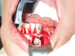 Before Surgical Exposure of Impacted Canine